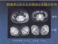 德永勝人・力士腹部大腿CT像.jpg